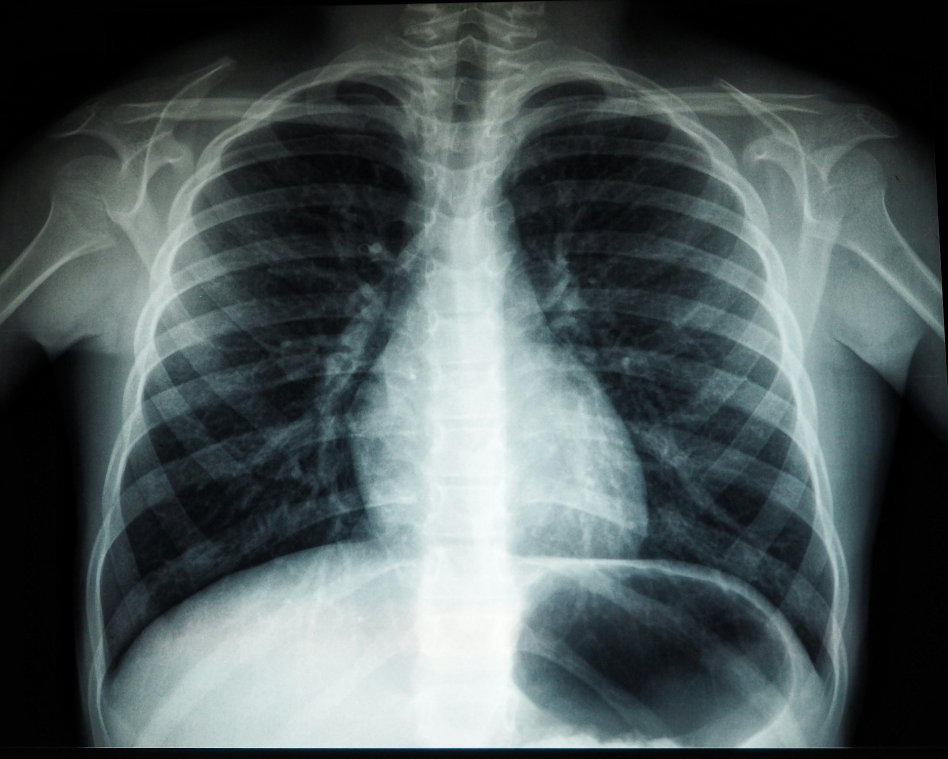 XRay